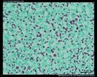 staphylococcus Ziehl-Neelsen stain